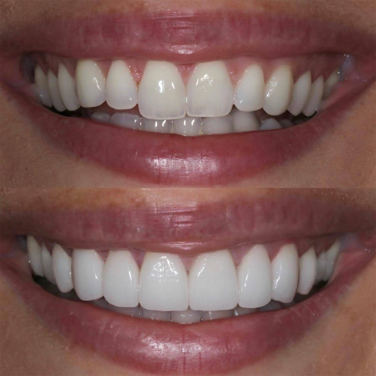 Tooth Contouring-01