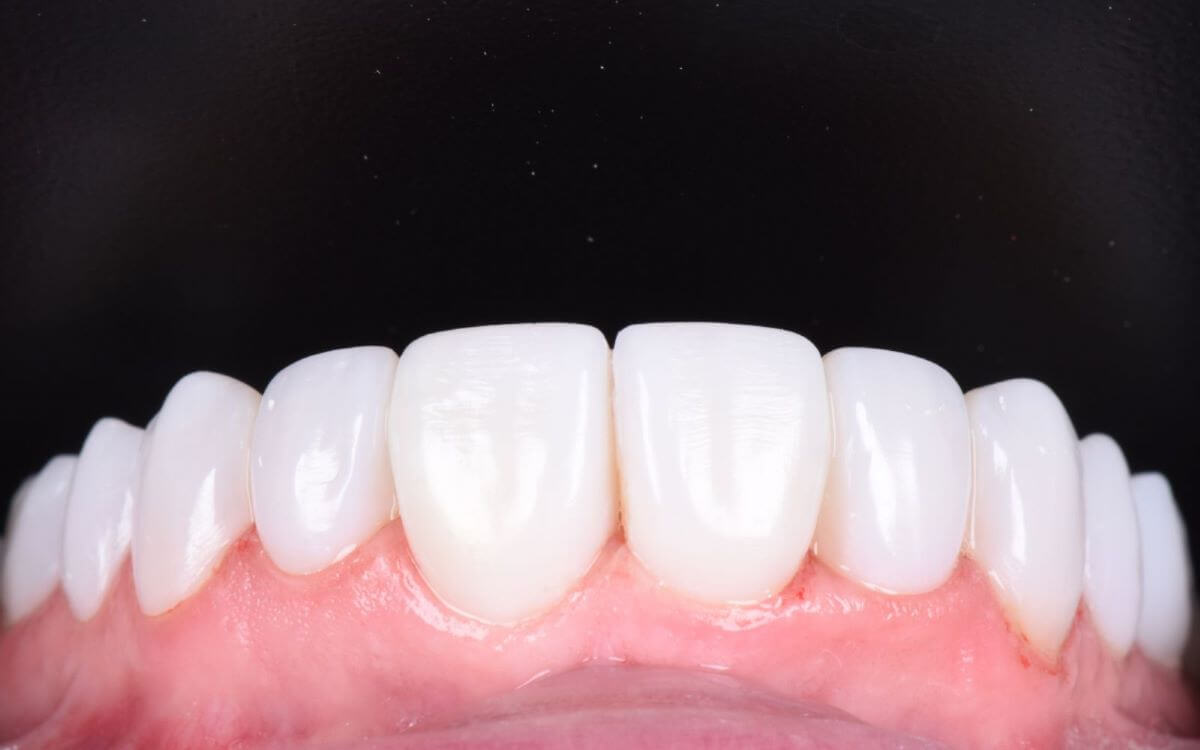 Tooth Contouring-03