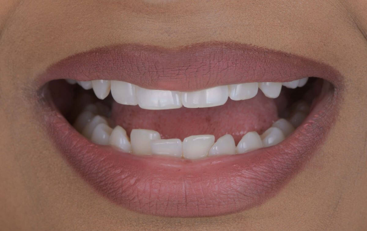 Tooth Contouring-04